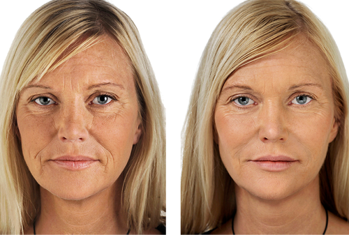 prima-dopo-biostimolazione prima-dopo-biostimolazione